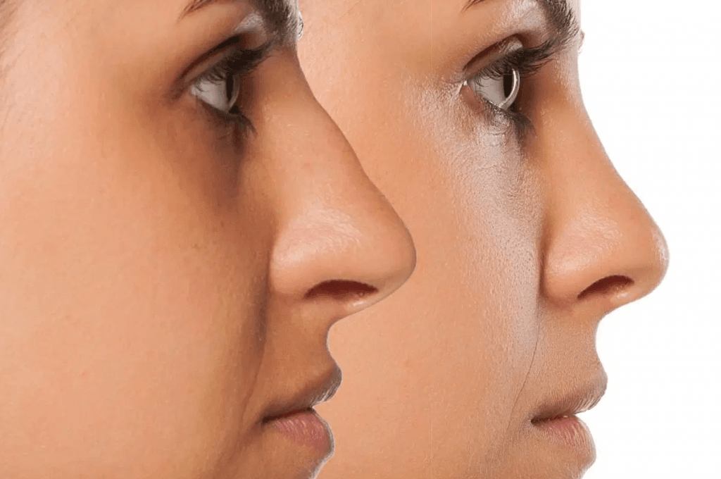 A BETTER LOOKING OR BETTER BREATHING NOSE