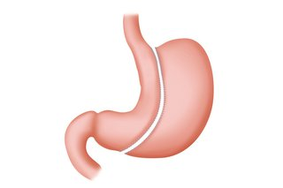 Manșon gastric
