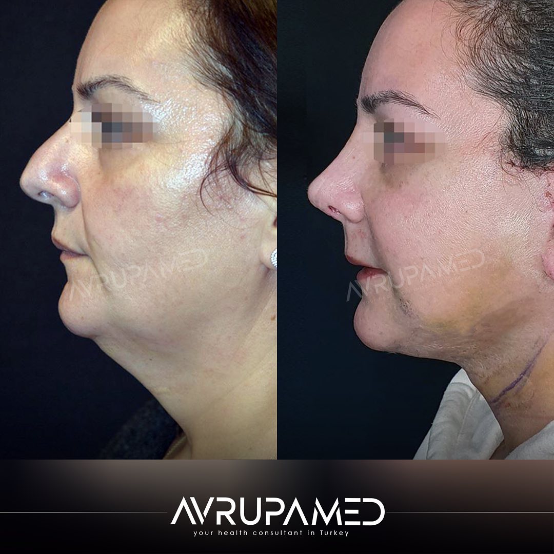 Facelift