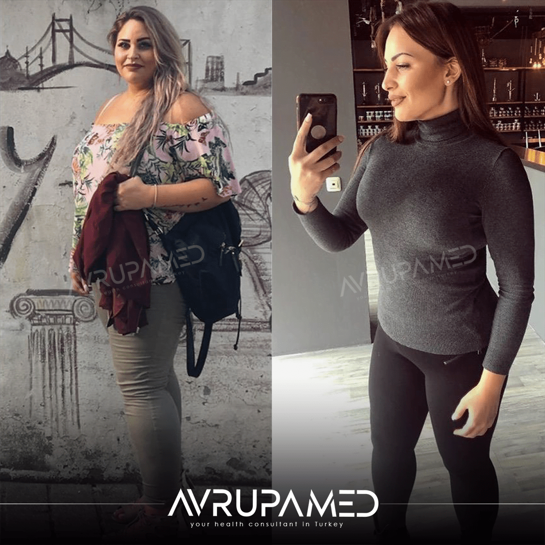 الالتفافية المعدية