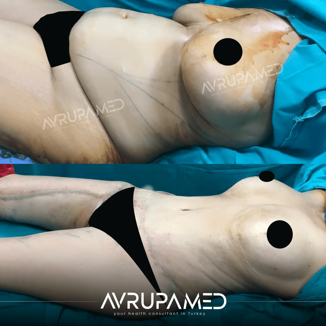 Bauchdeckenstraffung (Abdominoplastik)